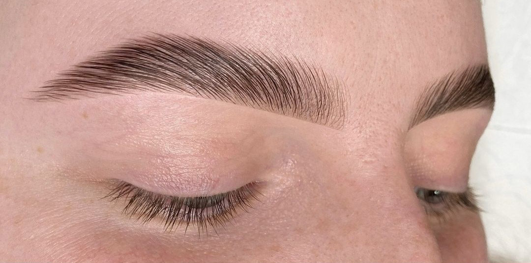 brow lift